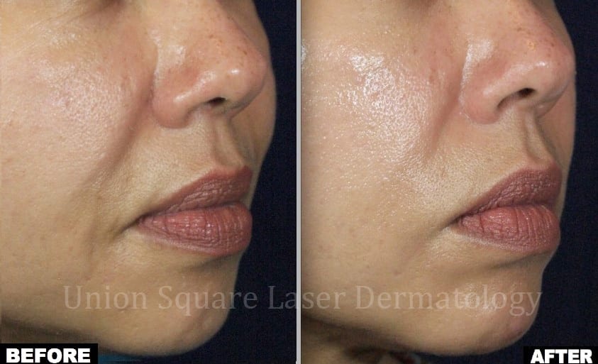 Ultherapy naso-labial fold before and after photos