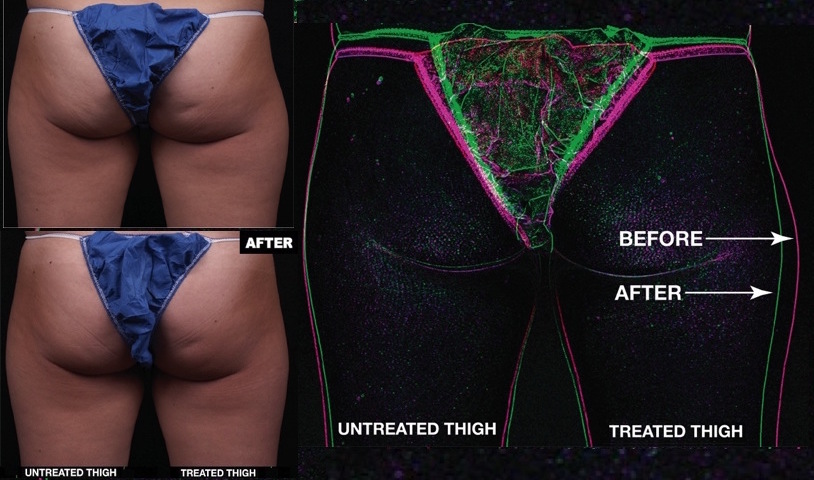 One thigh treatment with truSculpt, overlay silhouette One thigh treatment with truSculpt, overlay silhouette