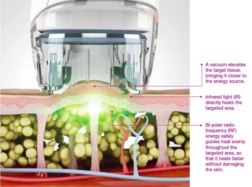 How Velashape Technology Works