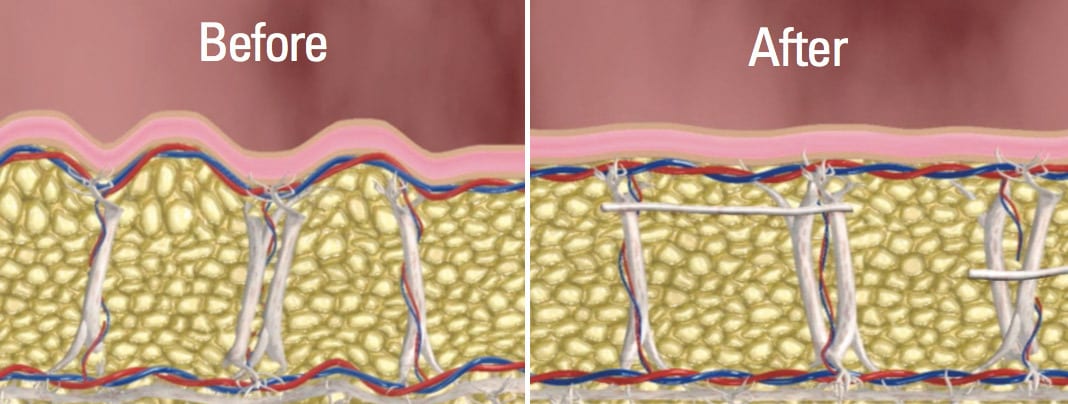 Cellfina treatment histology