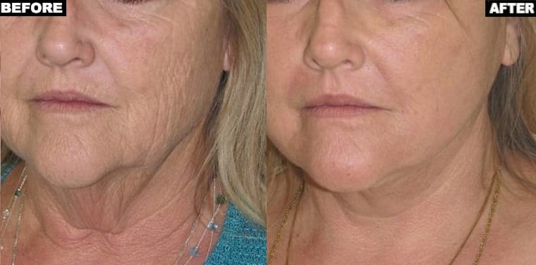 Sun damage treatment with Fraxel Repair