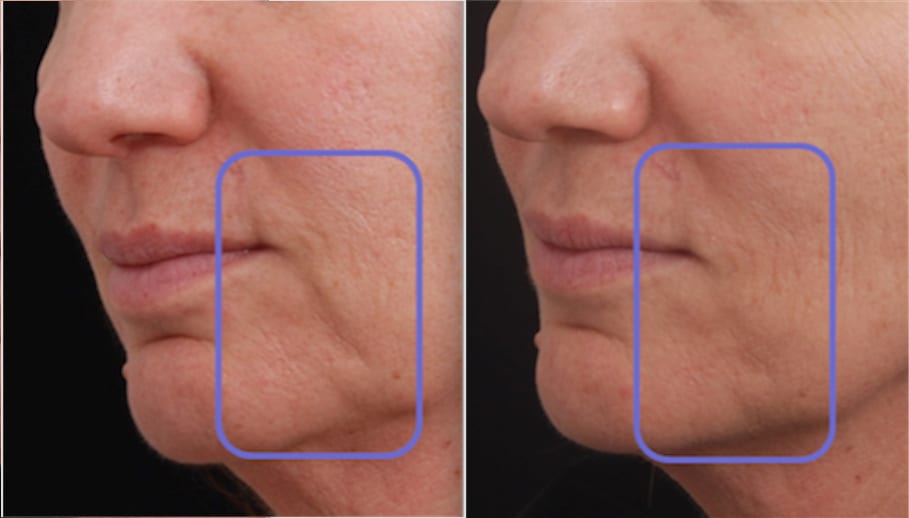 41 year old patient before treatment and 1 month after 1 Intensif RF Microneedle treatment in indicated area under the mouth.