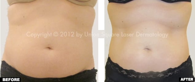 Liposonix treatment before and after front view
