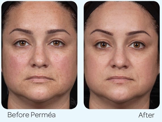 Clear and Brilliant Permea and Skinceuticals CE Ferrulic treatment