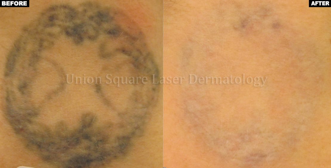 Tattoo removal with Alex laser (5 treatments)