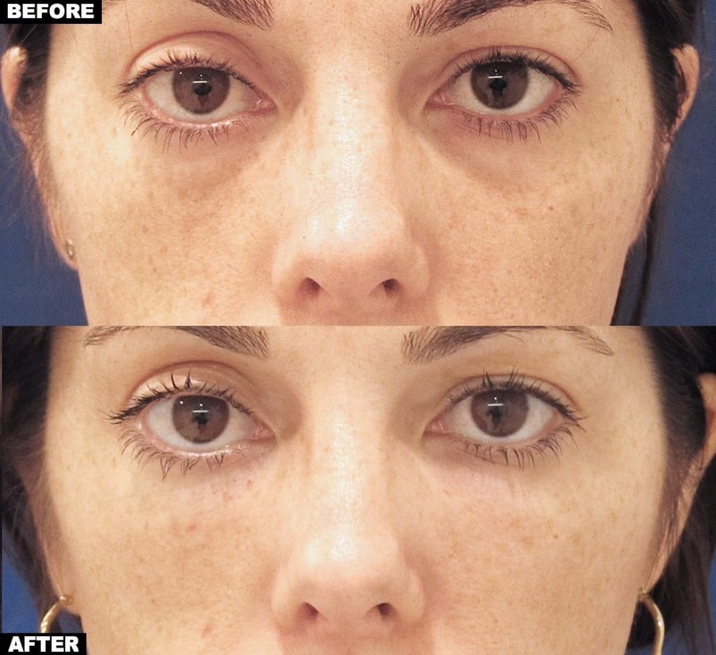 Tear trough filler treatment