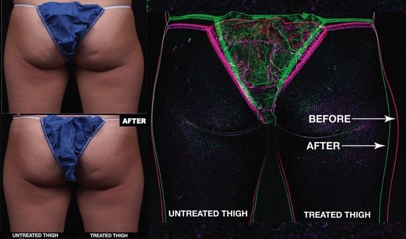Before and After photos for right thigh treatment with truSculpt