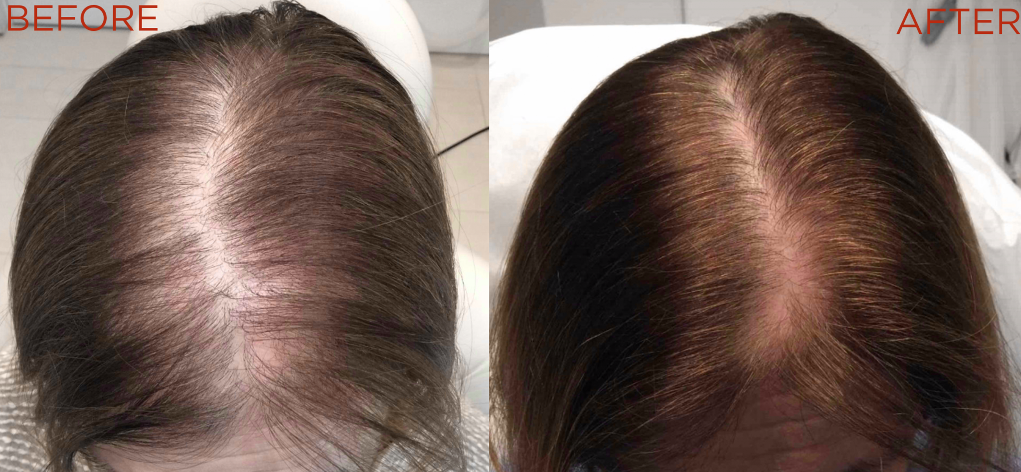 Platelet Rich Plasma (PRP) Therapy - UnionDerm - The Art + Science of Skin Platelet Rich Plasma (PRP) Therapy - UnionDerm - The Art + Science of Skin