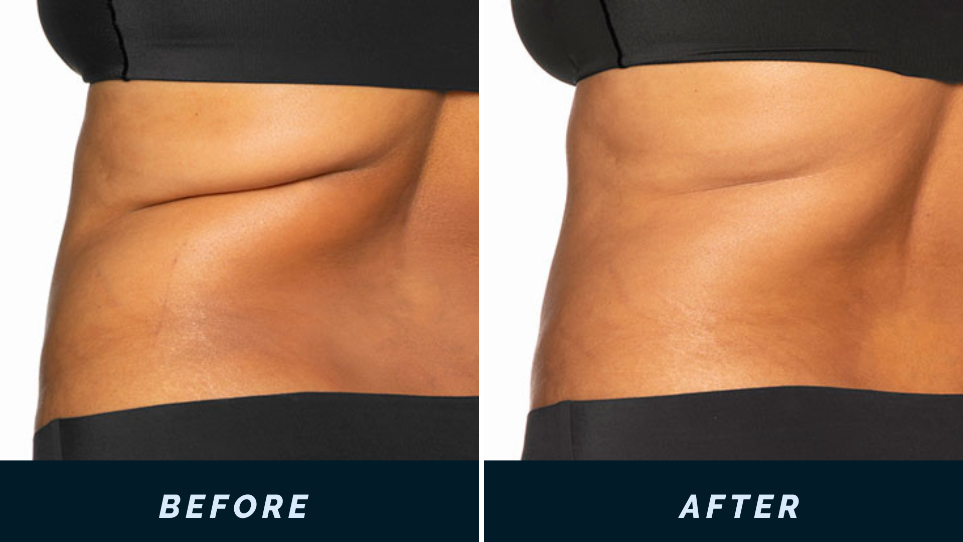 CoolSculpting Elite, Fat Reduction