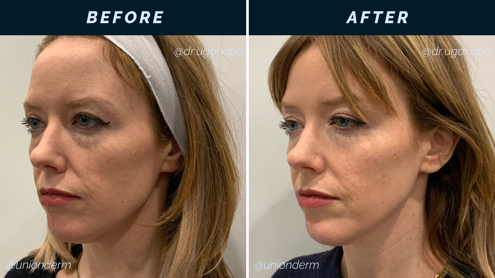 Pan-Facial Filler