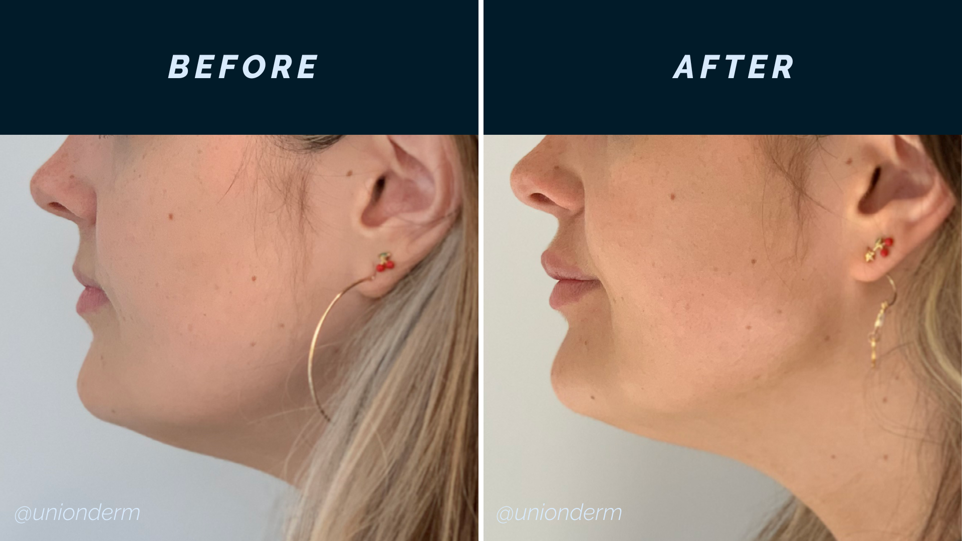 Filler for Jawline Definition & Lips