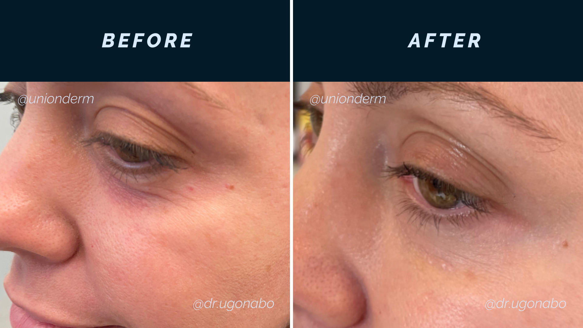 Filler for Under Eyes / Tear Troughs