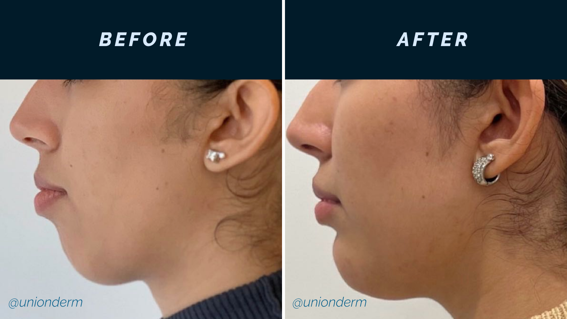 Filler for Facial Balancing (Chin Filler)