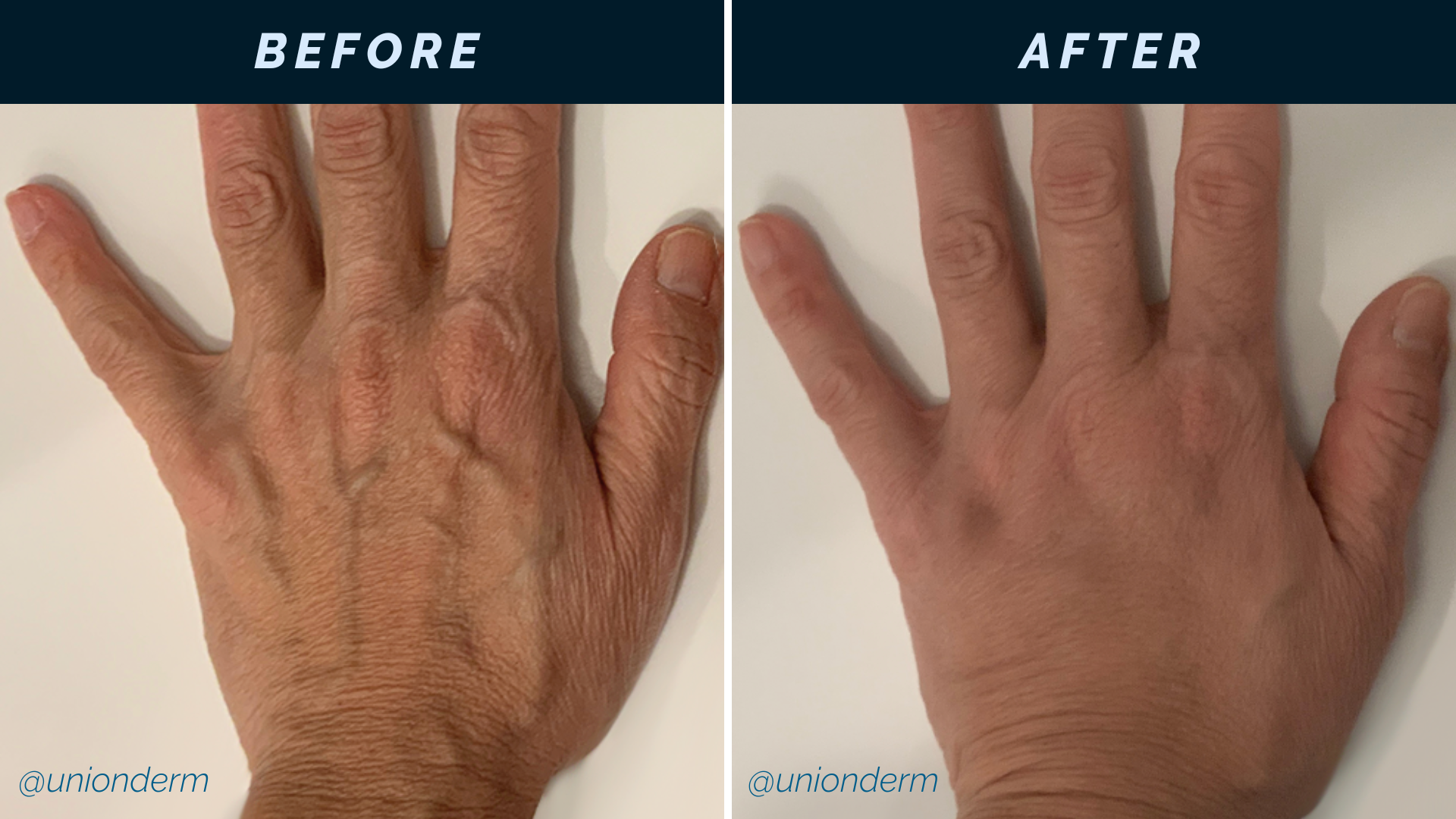 Filler for Hand Rejuvenation