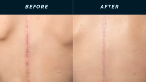 Scar Revision in New York City