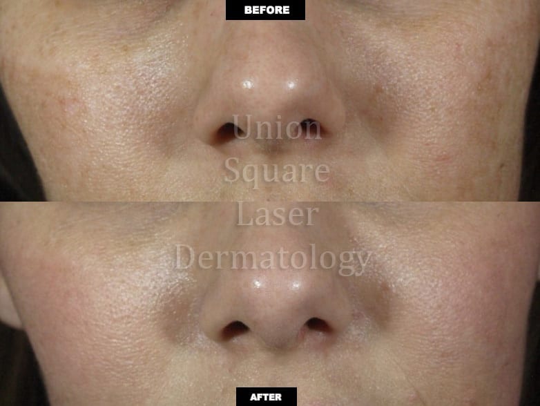 Brown spots on cheeks after one treatment with Fraxel Restore Dual laser