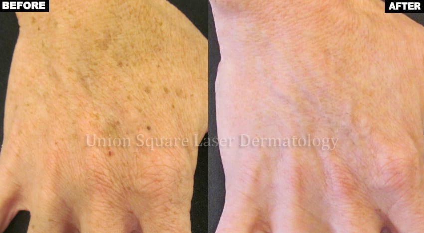 Brown spots on hands before and after one treatment with Alex TriVantage laser