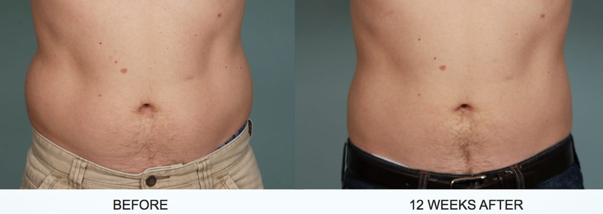 Coolsculpting in flanks and abdominal area, male patient, before treatment and after 12 weeks