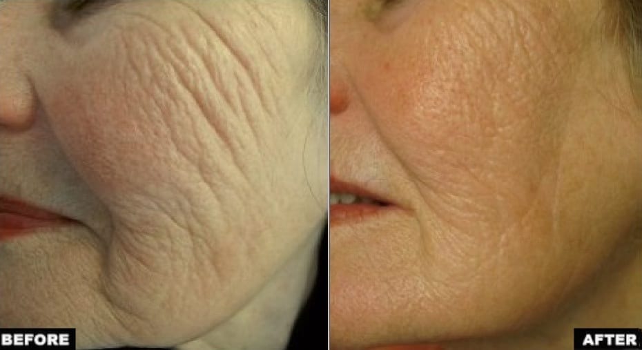 Facial skin laxity treatment before and after photos–Evolastin