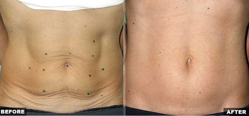 Abdominal skin laxity treatment before and after photos–Thermage